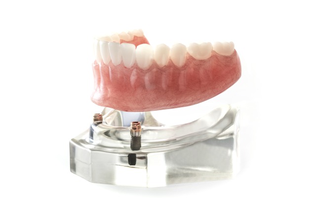 インプラントアシスト義歯（IA-RPD、IOD）